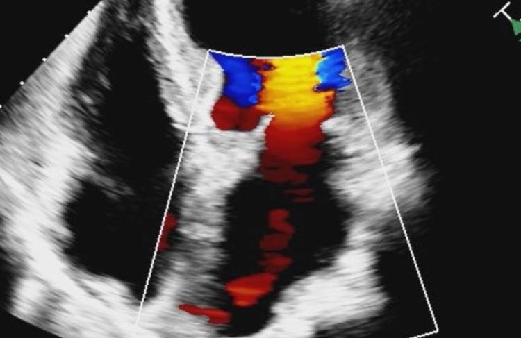 ultrasound image of the heart