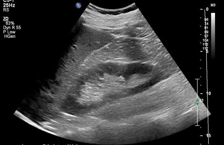 ultrasound image of adult abdomen