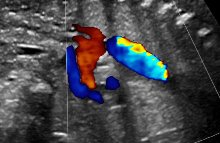 ultrasound image of the fetal heart
