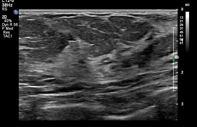 ultrasound image of normal breast tissue