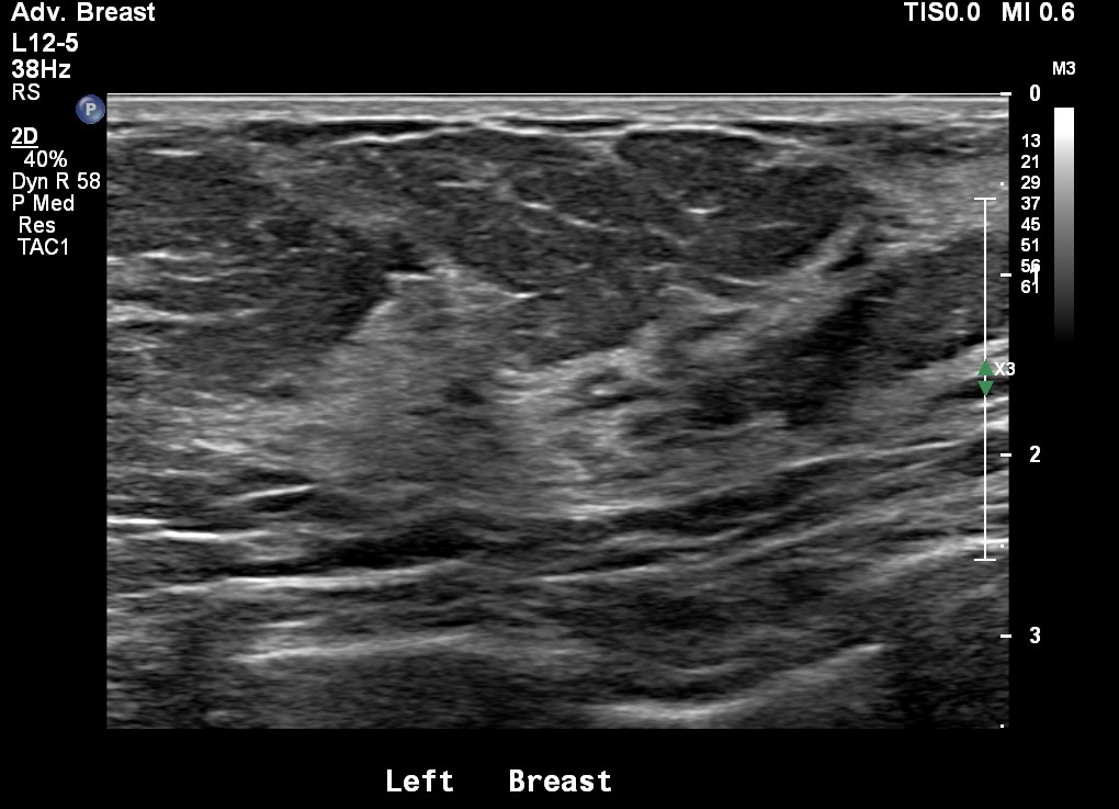 ultrasound image of normal breast tissue